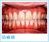 外科矯正・症例１・治療後